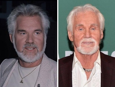 A picture of Kenny Rogers before (left) and after (right) eyelids surgery.